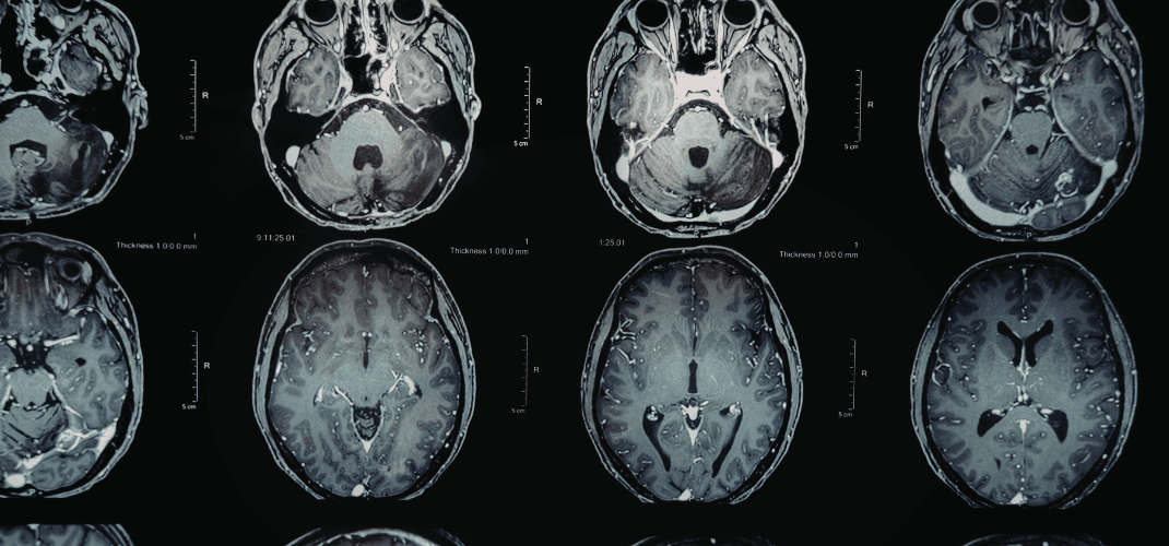 Understanding Fractional Anisotropy (FA)
